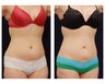 Liposuction