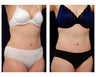 Liposuction