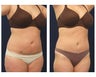 Liposuction