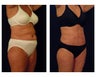 Liposuction