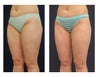 Liposuction