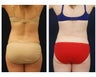 Liposuction