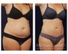 Liposuction