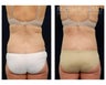 Liposuction