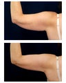 Liposuction
