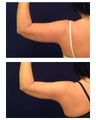 Liposuction