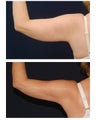 Liposuction