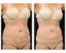 Liposuction