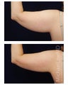 Liposuction