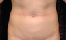 Liposuction of Abdomen