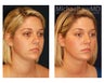 Chin Liposuction
