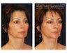 Chin Liposuction