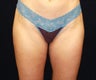 Liposuction of Saddlebags
