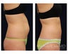 Liposuction