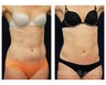 Liposuction