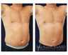 Liposuction