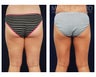 Liposuction