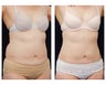 Liposuction