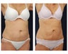 Liposuction