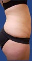 Abdomen Liposuction