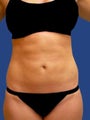 Abdomen Liposuction