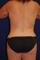 Back / Waist Liposuction