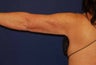 Liposuction Upper Arm
