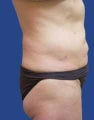Abdomen Liposuction