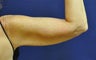 Liposuction Upper Arm
