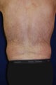 Liposuction of Waist