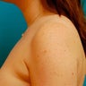 Liposuction of Underarm Area