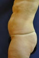 Liposuction of Abdomen