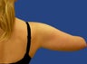 Liposuction of the Upper Arm