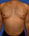 Male Breast Reduction