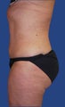 Liposuction of Abdomen