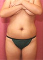 Tumescent Liposuction