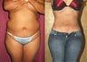 Tumescent Liposuction