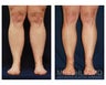 Liposuction