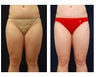 Liposuction