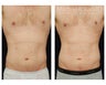 Liposuction