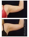 Liposuction