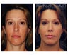 Chin Liposuction
