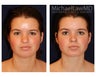 Chin Liposuction
