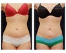 Liposuction