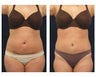 Liposuction