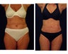 Liposuction