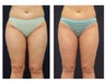 Liposuction