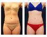 Liposuction