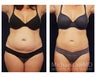 Liposuction