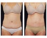 Liposuction